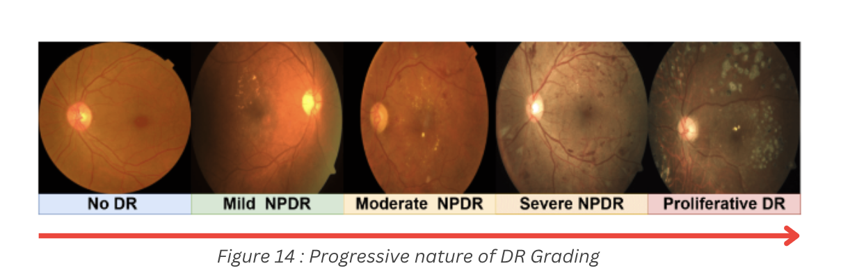 Diabetic retinopathy grading progression from no DR to proliferative DR
